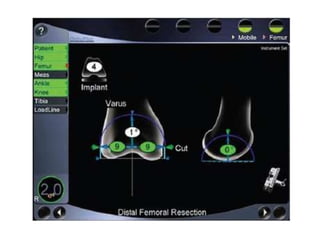 • Computer navigation systems also can aid in
determining the proper implant size as well as
alignment. Soft tissue balancing and measurement
of flexion and extension gaps during the procedure
are other significant advantages to computer-
assisted TKA.
• Objective measurement of the gaps ensures proper
soft tissue balancing and gaps that will provide a
stable joint throughout a range of motion.
• Another advantage of computer navigation is
avoidance of violation of the femoral intramedullary
canal, which may reduce blood loss and cardiac-
related complications because fewer emboli are
placed into the venous system than with placement
of an intramedullary alignment rod.
 