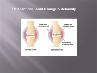 Osteoarthritis: Joint Damage & Deformity
 