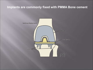Implants are commonly fixed with PMMA Bone cement
 