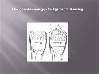 Flexion-extension gap for ligament balancing
 