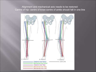 Alignment and mechanical axis needs to be restored:
Centre of hip- centre of knee-centre of ankle should fall in one line
 