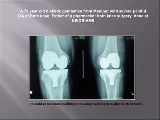 A 79 year old diabetic gentleman from Manipur with severe painful
OA of Both knee; Father of a pharmacist: both knee surgery done at
NEIGRIHMS
He could go back home walking with a single walking stick after stitch removal.
 
