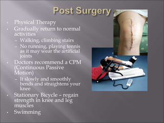 • Physical Therapy
• Gradually return to normal
activities
– Walking, climbing stairs
– No running, playing tennis
as it may wear the artificial
joints
• Doctors recommend a CPM
(Continuous Passive
Motion)
– It slowly and smoothly
bends and straightens your
knee
• Stationary Bicycle – regain
strength in knee and leg
muscles
• Swimming
 