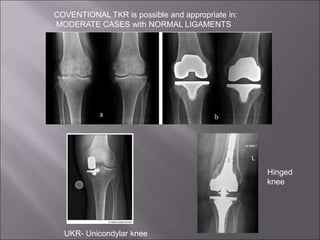 COVENTIONAL TKR is possible and appropriate in:
MODERATE CASES with NORMAL LIGAMENTS
UKR- Unicondylar knee
Hinged
knee
 