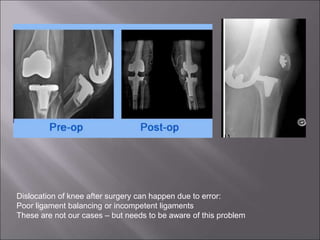Dislocation of knee after surgery can happen due to error:
Poor ligament balancing or incompetent ligaments
These are not our cases – but needs to be aware of this problem
 