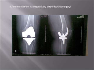 Knee replacement is a deceptively simple looking surgery!
 