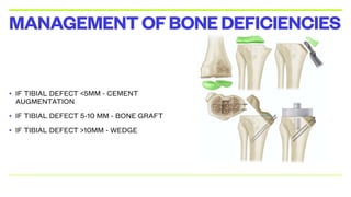 • IF TIBIAL DEFECT <5MM - CEMENT
AUGMENTATION
• IF TIBIAL DEFECT 5-10 MM - BONE GRAFT
• IF TIBIAL DEFECT >10MM - WEDGE
MANAGEMENTOFBONEDEFICIENCIES
 