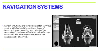 • Screen simulating the femoral cut after carrying
out the tibial cut. All the variables (sizes of
femur and insert, rotation and height of the
femoral cut) can be modified and their effect on
the lateral and medial flexion and extension
spaces can be observed.
NAVIGATIONSYSTEMS
 