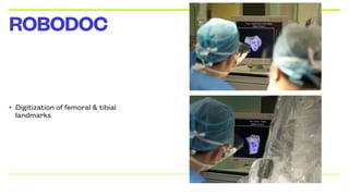 • Digitization of femoral & tibial
landmarks
ROBODOC
 