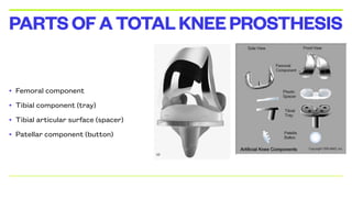 • Femoral component
• Tibial component (tray)
• Tibial articular surface (spacer)
• Patellar component (button)
PARTSOFATOTALKNEEPROSTHESIS
 