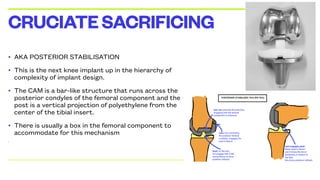 • AKA POSTERIOR STABILISATION
• This is the next knee implant up in the hierarchy of
complexity of implant design.
• The CAM is a bar-like structure that runs across the
posterior condyles of the femoral component and the
post is a vertical projection of polyethylene from the
center of the tibial insert.
• There is usually a box in the femoral component to
accommodate for this mechanism
•
CRUCIATESACRIFICING
 