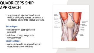 QUADRICEPS SNIP
APPROACH
• snip made at apex of quadriceps
tendon obliquely across tendon at a
45-degree angle into vastus lateralis
Advantages
• no change in post-operative
protocol
• minimal, if any, long-term
consequences
Disadvantages
• not as extensile as a turndown or
tibial tubercle osteotomy
 