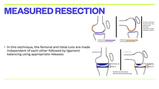• In this technique, the femoral and tibial cuts are made
independent of each other followed by ligament
balancing using appropriate releases
MEASUREDRESECTION
 