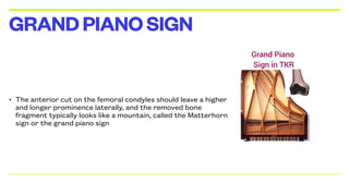 • The anterior cut on the femoral condyles should leave a higher
and longer prominence laterally, and the removed bone
fragment typically looks like a mountain, called the Matterhorn
sign or the grand piano sign
GRANDPIANOSIGN
 