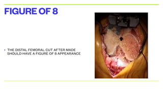 • THE DISTAL FEMORAL CUT AFTER MADE
SHOULD HAVE A FIGURE OF 8 APPEARANCE
FIGUREOF8
 