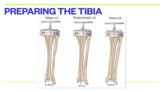 PREPARINGTHETIBIA
 