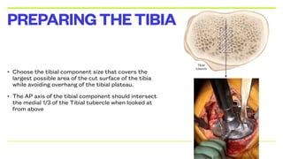 • Choose the tibial component size that covers the
largest possible area of the cut surface of the tibia
while avoiding overhang of the tibial plateau.
• The AP axis of the tibial component should intersect
the medial 1/3rd
of the Tibial tubercle when looked at
from above
PREPARINGTHETIBIA
 