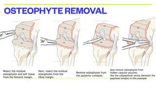 OSTEOPHYTEREMOVAL
Resect the residual
osteophytes and soft tissue
from the femoral margin.
Next, resect the residual
osteophytes from the
tibial margin.
Remove osteophytes from
the posterior condyles.
Also remove osteophytes from
hidden capsular pouches,
like the subpopliteal recess (beneath the
popliteal tendon) in this example
 