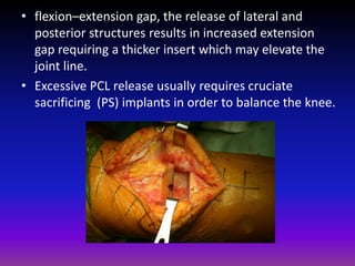 TKR in valgus knee.pptx