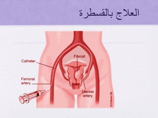 ‫بالقسطرة‬ ‫العالج‬
 
