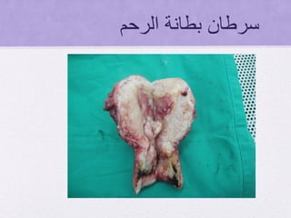 ‫الرحم‬ ‫بطانة‬ ‫سرطان‬
 