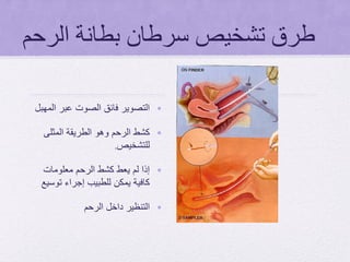 ‫الرحم‬ ‫بطانة‬ ‫سرطان‬ ‫تشخيص‬ ‫طرق‬
•‫المهبل‬ ‫عبر‬ ‫الصوت‬ ‫فائق‬ ‫التصوير‬
•‫المثلى‬ ‫الطريقة‬ ‫وهو‬ ‫الرحم‬ ‫كشط‬
‫للتشخيص‬.
•‫معلومات‬ ‫الرحم‬ ‫كشط‬ ‫يعط‬ ‫لم‬ ‫إذا‬
‫توسيع‬ ‫إجراء‬ ‫للطبيب‬ ‫يمكن‬ ‫كافية‬
•‫الرحم‬ ‫داخل‬ ‫التنظير‬
 
