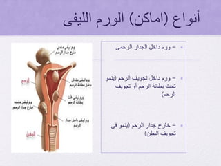 ‫أنواع‬(‫اماكن‬)‫الليفى‬ ‫الورم‬
•-‫الرحمى‬ ‫الجدار‬ ‫داخل‬ ‫ورم‬
•-‫تجويف‬ ‫داخل‬ ‫ورم‬‫الرحم‬(‫ينمو‬
‫تجويف‬ ‫أو‬ ‫الرحم‬ ‫بطانة‬ ‫تحت‬
‫الرحم‬)
•-‫جدار‬ ‫خارج‬‫الرحم‬(‫فى‬ ‫ينمو‬
‫البطن‬ ‫تجويف‬)
 