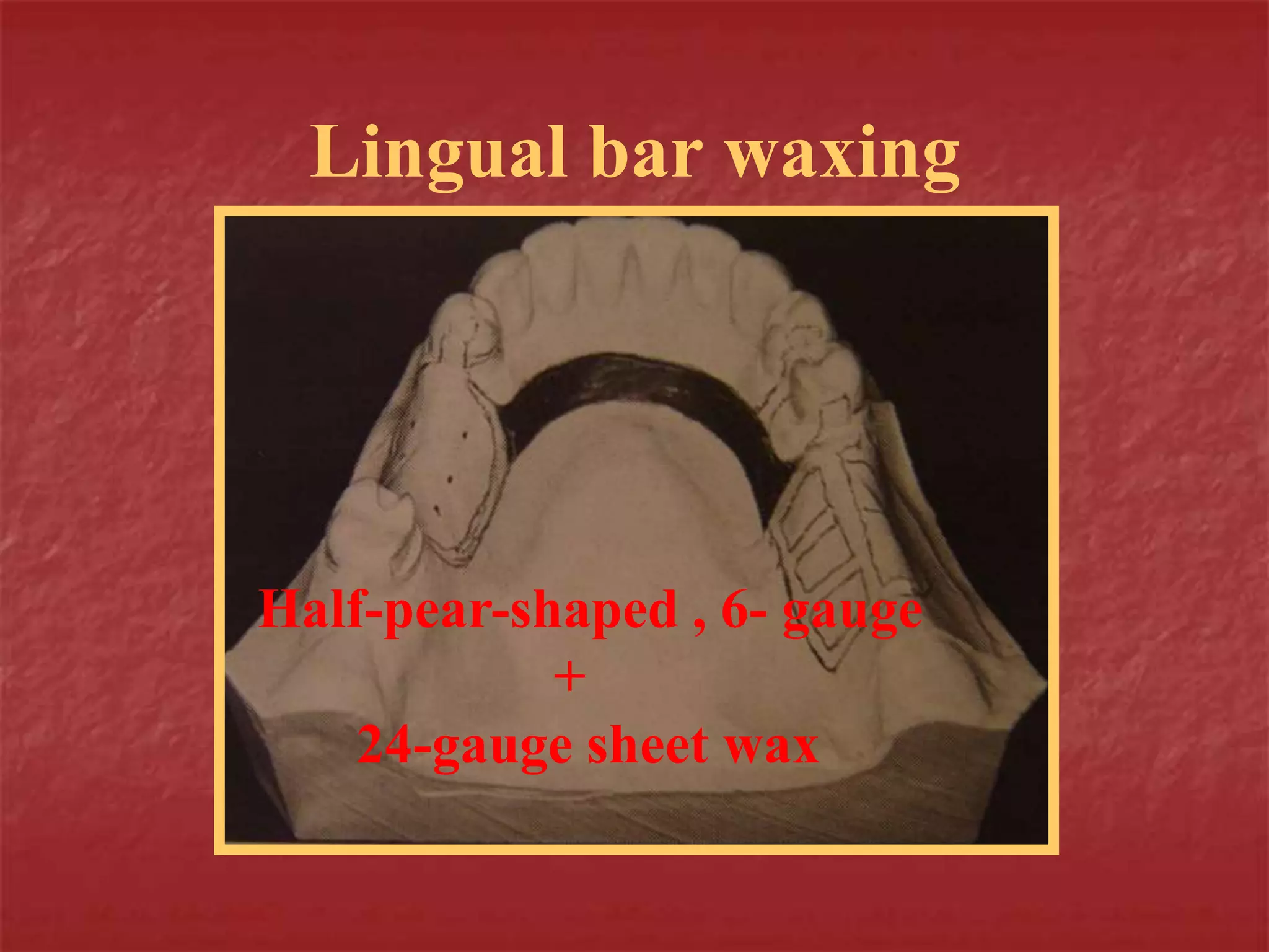 Lingual bar waxing 
Half-pear-shaped , 6- gauge 
+ 
24-gauge sheet wax 
 