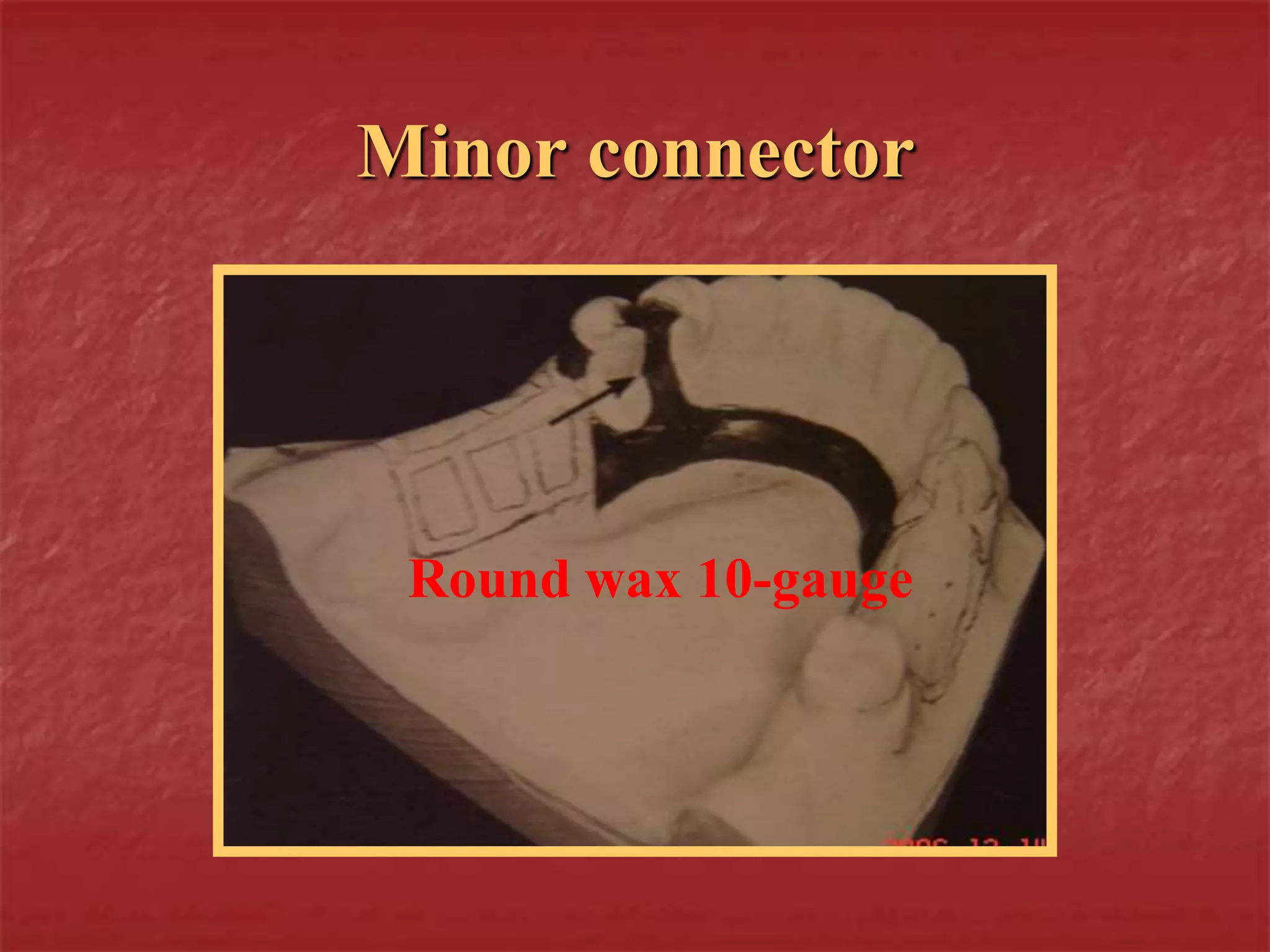Minor connector 
Round wax 10-gauge 
 
