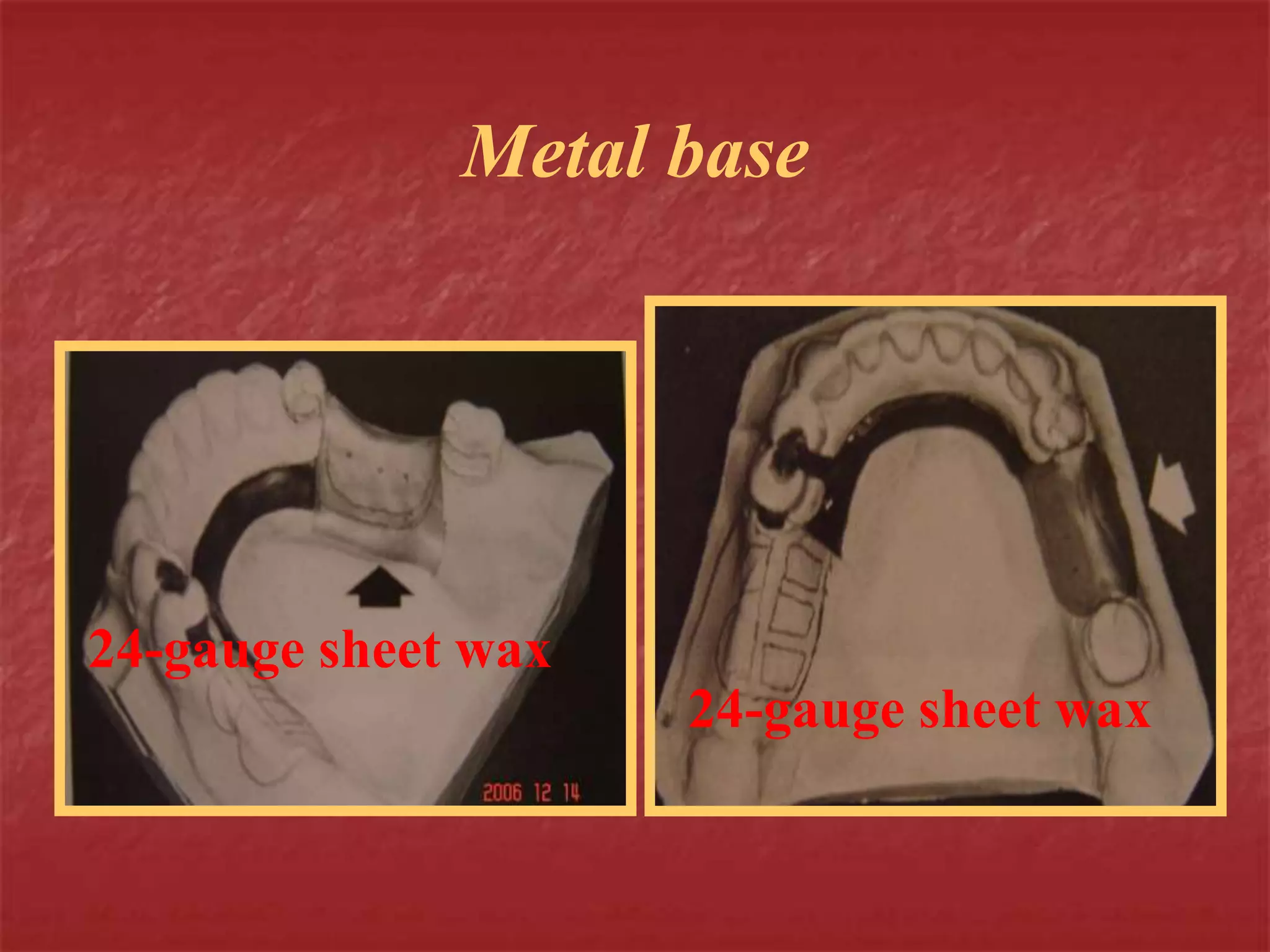 Metal base 
24-gauge sheet wax 
24-gauge sheet wax 
 