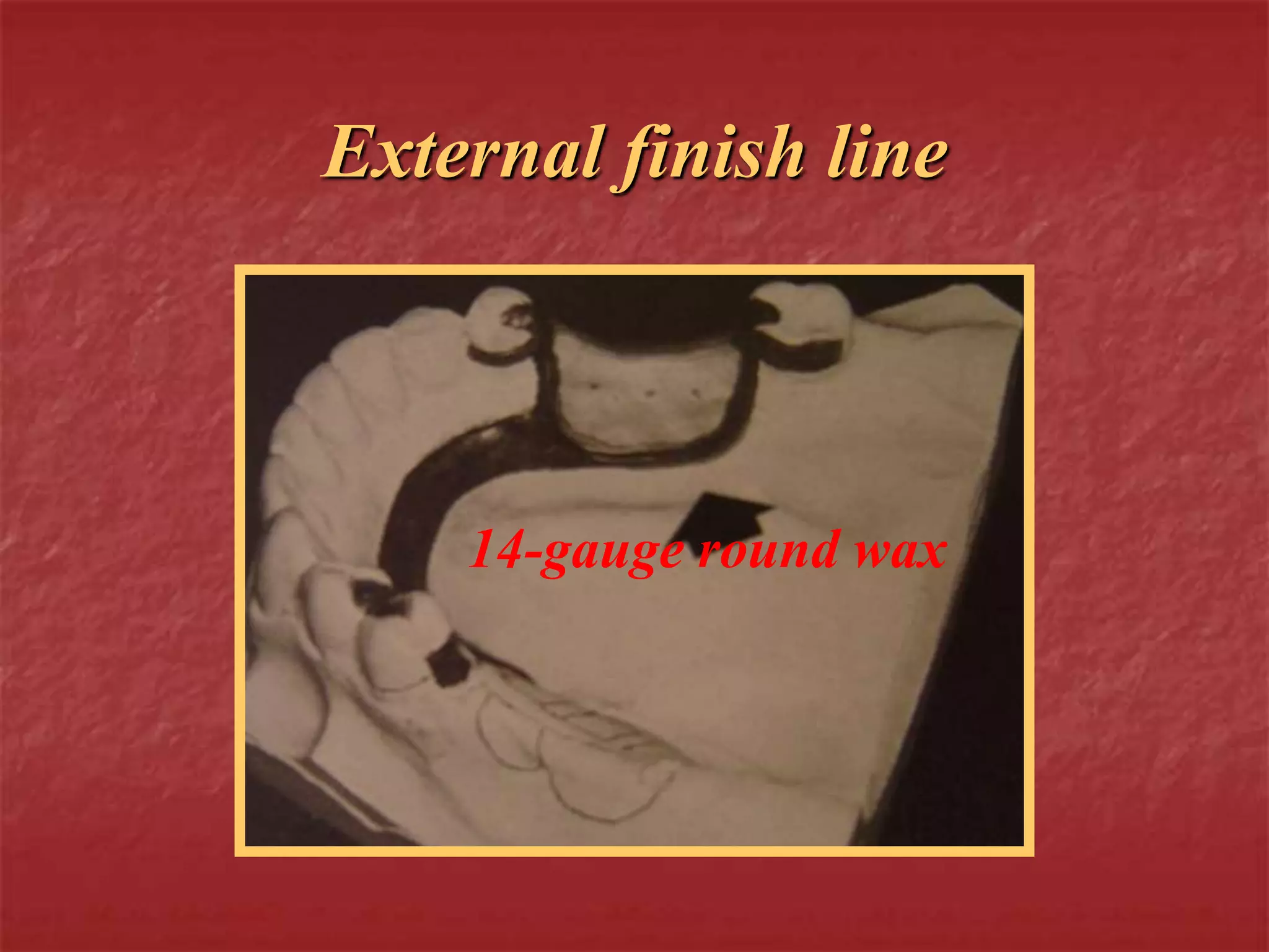 External finish line 
14-gauge round wax 
 
