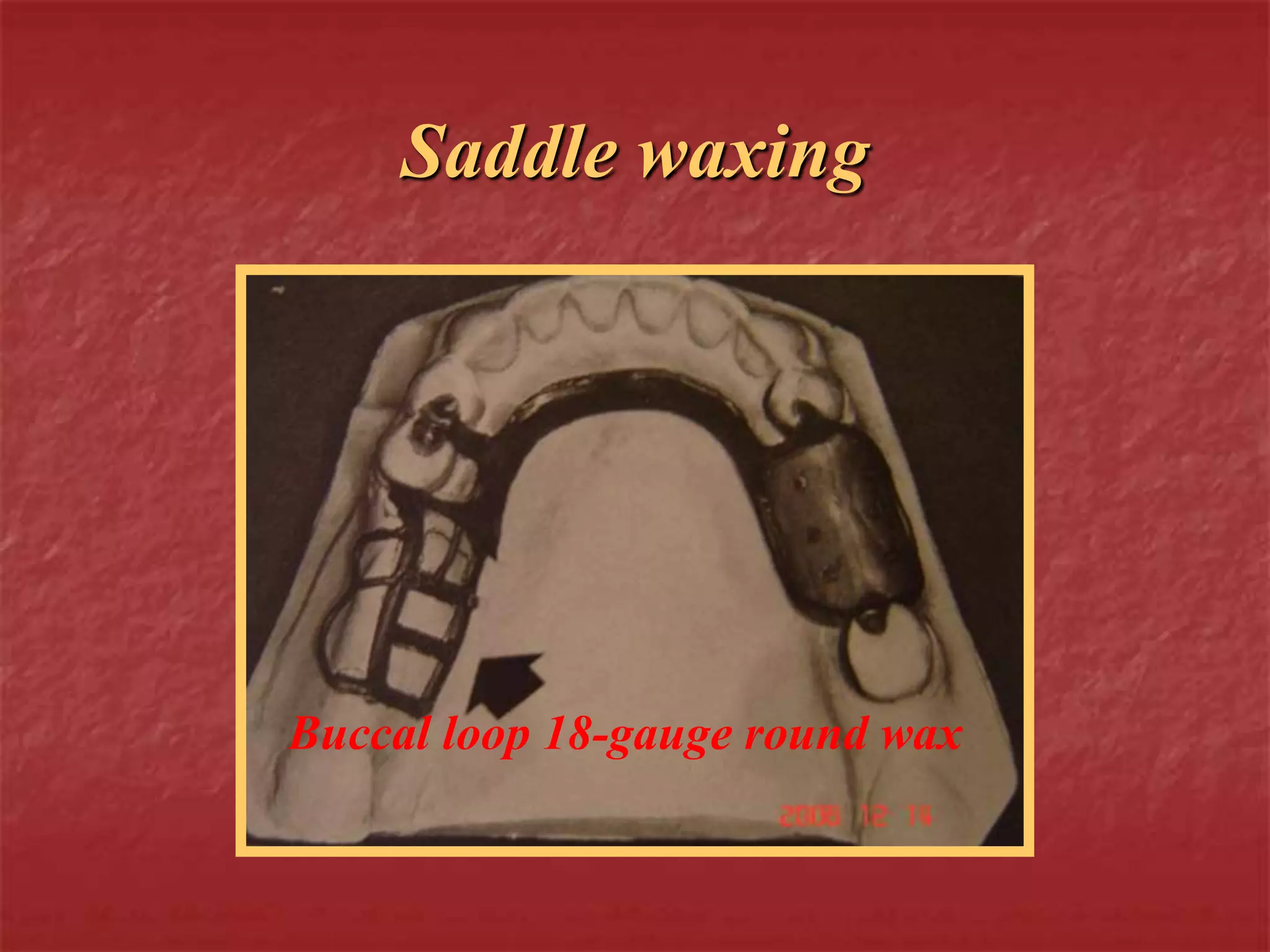 Saddle waxing 
Buccal loop 18-gauge round wax 
 