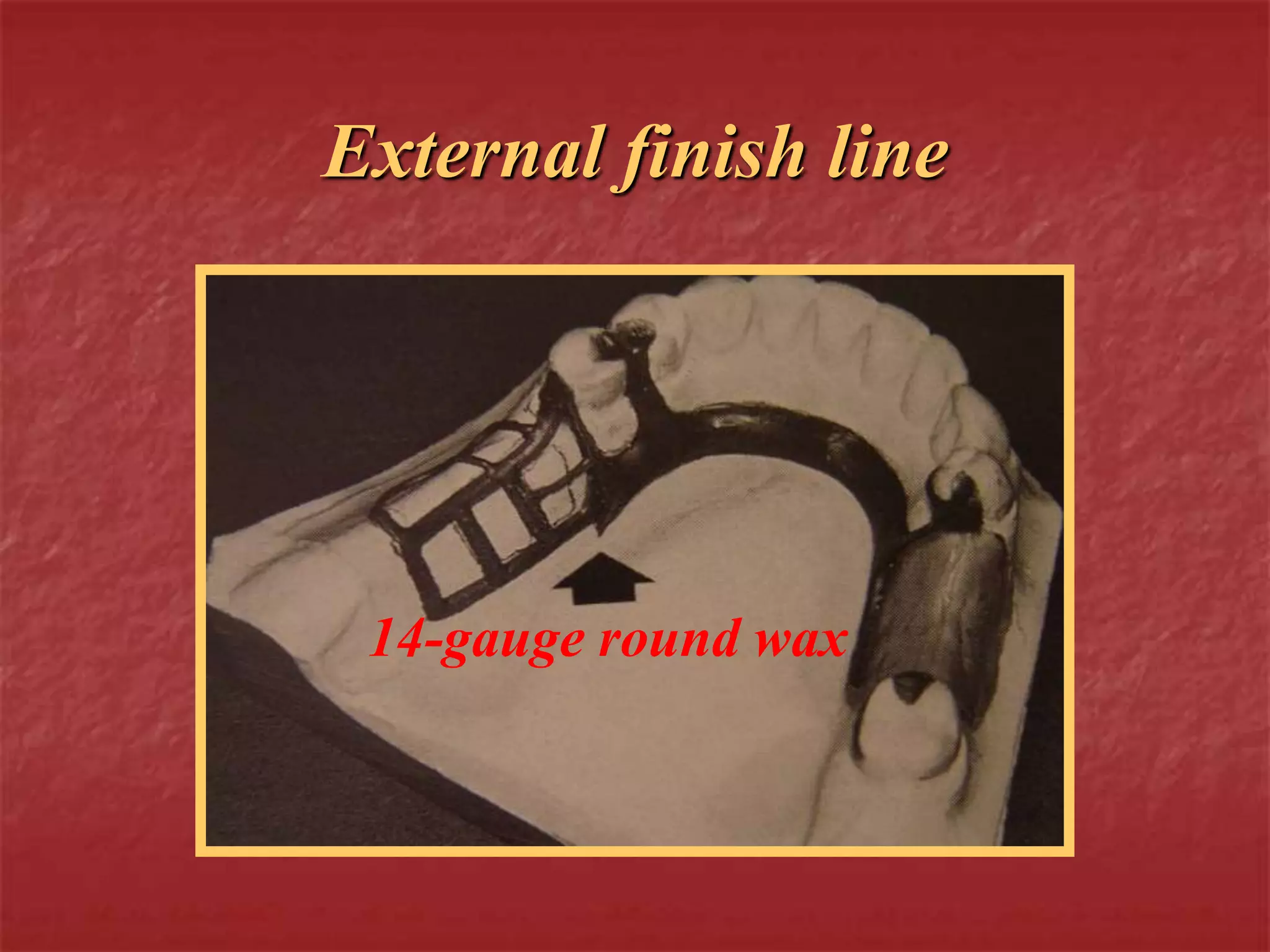 External finish line 
14-gauge round wax 
 