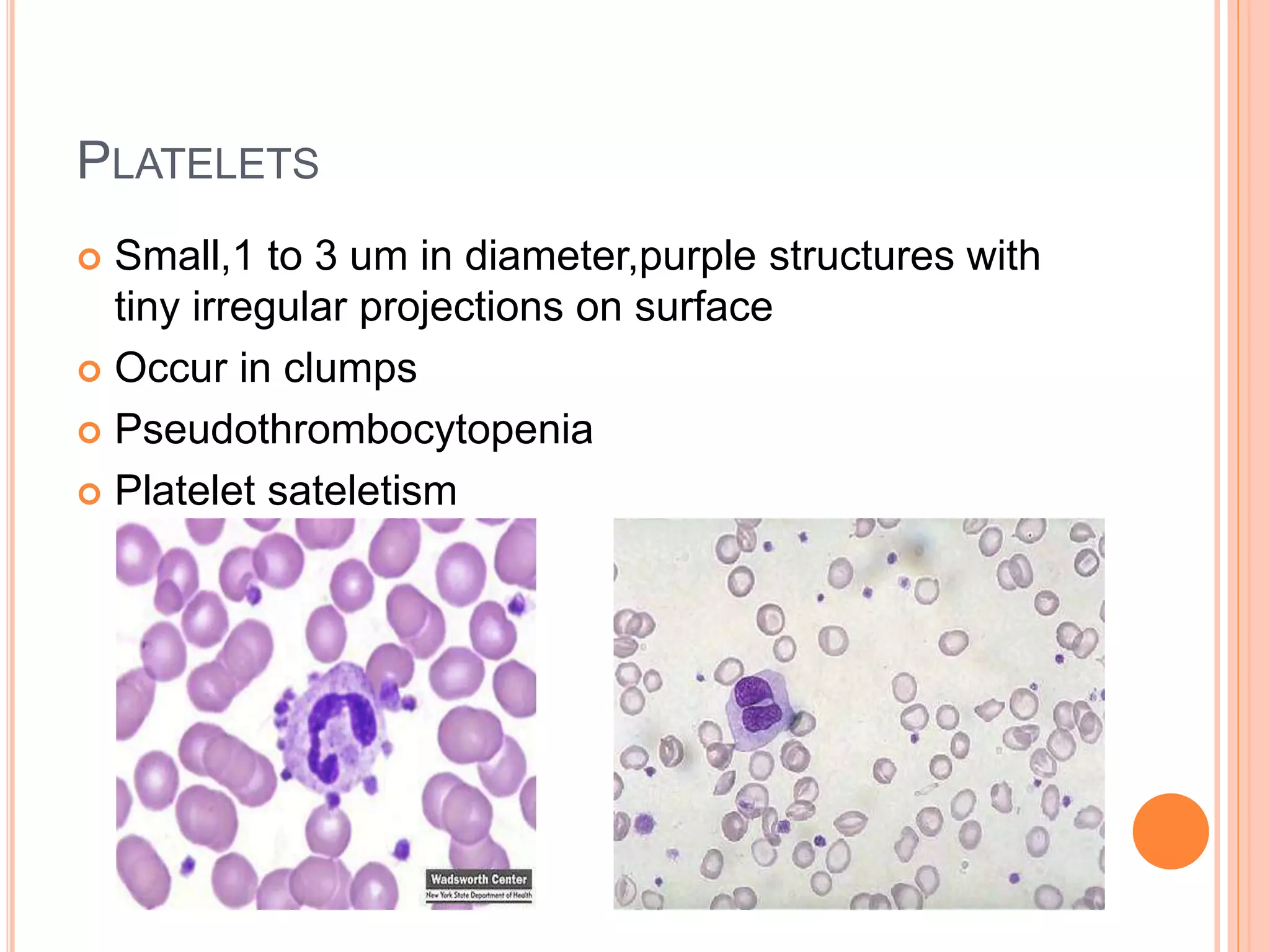 PLATELETS
 Small,1 to 3 um in diameter,purple structures with
tiny irregular projections on surface
 Occur in clumps
 Pseudothrombocytopenia
 Platelet sateletism
 