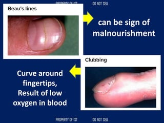 can be sign of
malnourishment
Curve around
fingertips,
Result of low
oxygen in blood
 
