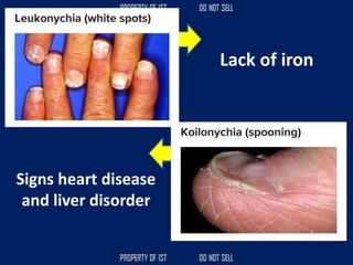 Lack of iron
Signs heart disease
and liver disorder
 