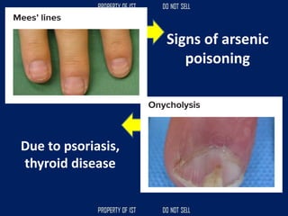 Signs of arsenic
poisoning
Due to psoriasis,
thyroid disease
 