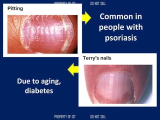 Common in
people with
psoriasis
Due to aging,
diabetes
 