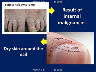 Result of
internal
malignancies
Dry skin around the
nail
 