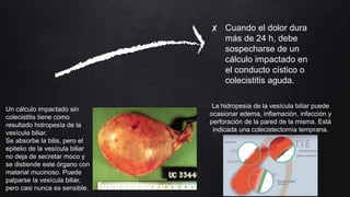 Colecistitis | PPTX