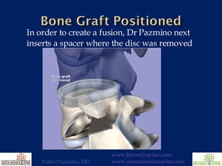 In order to create a fusion, Dr Pazmino next inserts a spacer where the disc was removed 