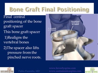 Final  central positioning of the bone graft spacer This bone graft spacer   1)Realigns the  vertebral bones  2)The spacer also lifts  pressure from the  pinched nerve roots. 