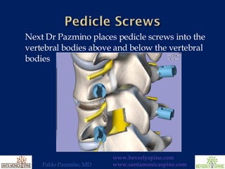 Next Dr Pazmino places pedicle screws into the vertebral bodies above and below the vertebral bodies 