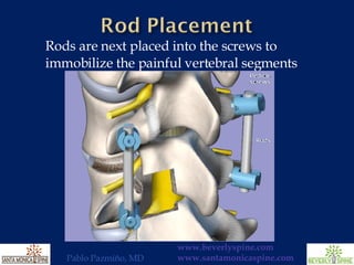 Rods are next placed into the screws to immobilize the painful vertebral segments 