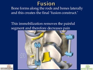 Bone forms along the rods and bones laterally and this creates the final ‘fusion construct.’ This immobilization removes the painful segment and therefore decreases pain 
