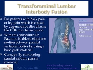 For patients with back pain or leg pain which is caused by degenerative disc disease the TLIF may be an option With this procedure Dr. Pazmino is able to eliminate motion between painful vertebral bodies by using a bone graft material  Concept: By eliminating painful motion, pain is removed 