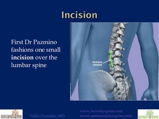First Dr Pazmino fashions one small  incision  over the lumbar spine 