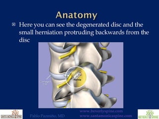 Here you can see the degenerated disc and the small herniation protruding backwards from the disc 
