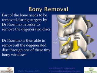 Part of the bone needs to be removed during surgery by Dr Pazmino in order to remove the degenerated discs Dr Pazmino is then able to remove all the degenerated disc through one of these tiny bony windows 