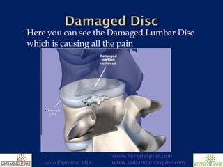 Here you can see the Damaged Lumbar Disc which is causing all the pain 